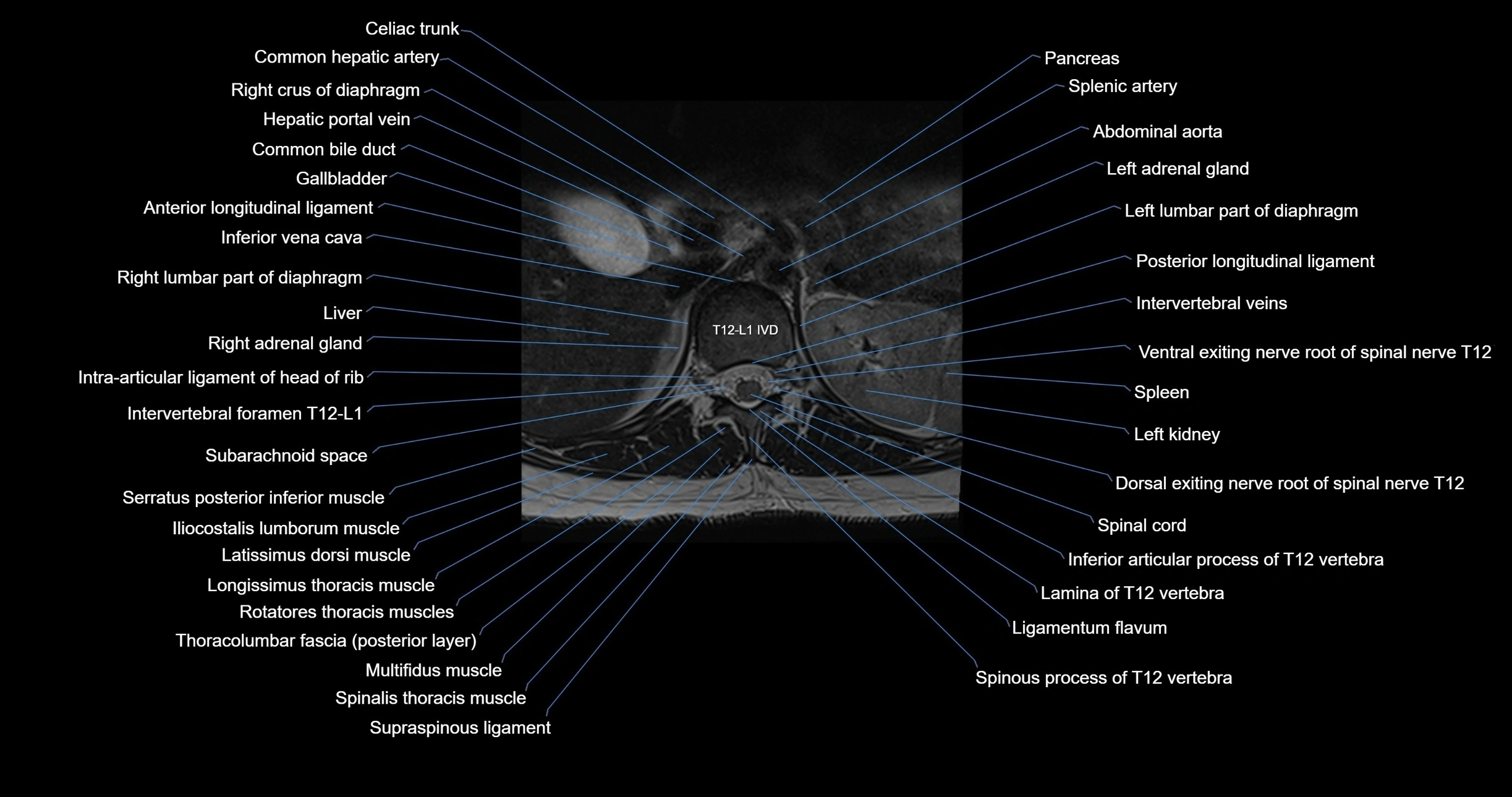 MRI lumbar spine axial cross sectional anatomy 3T radiology  image-img-00001-00003.webp
